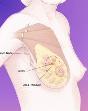 From Cure to Confidence – Complete Spectrum of Breast Surgery