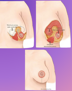 From Cure to Confidence – Complete Spectrum of Breast Surgery
