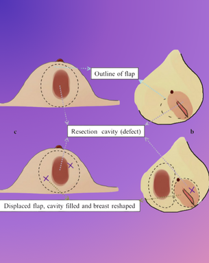 From Cure to Confidence – Complete Spectrum of Breast Surgery
