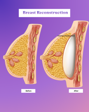 From Cure to Confidence – Complete Spectrum of Breast Surgery