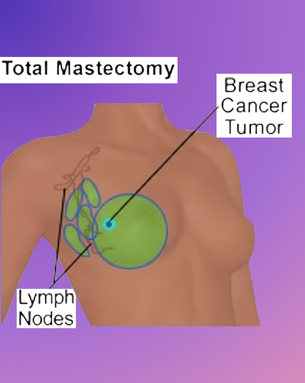 From Cure to Confidence – Complete Spectrum of Breast Surgery