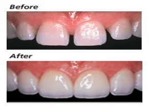 Teeth Gap Treatment