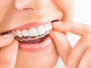 Invisible Braces