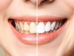 Dental Fluorosis Treatment