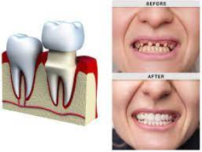 Dental Crowns