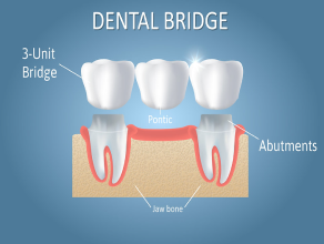 Dental Bridge