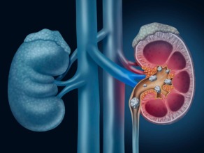 Kidney Diseases