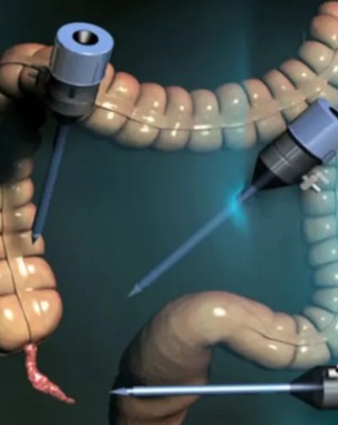 Appendectomy 