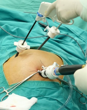 Cholecystectomy