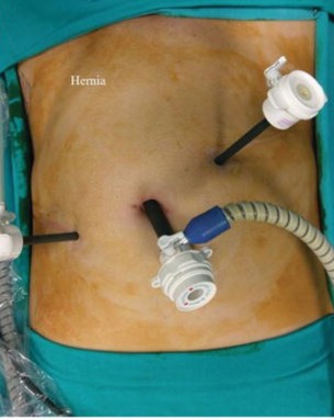 Hernia repair surgery