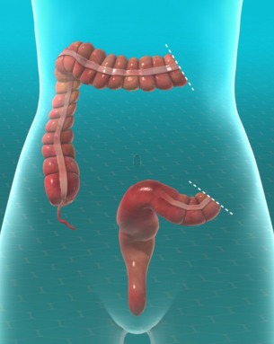 Colectomy
