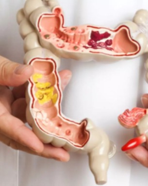 Rectal resection