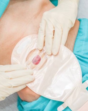 Colostomy
