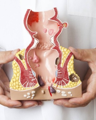 Hemorrhoidectomy