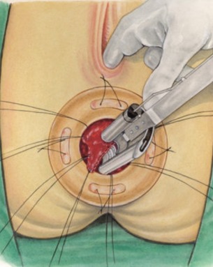 STARR (Stapled Transanal Rectal Resection)