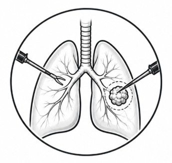 Lung Anomalies Surgery