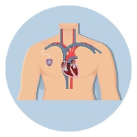 Chemoport Placement