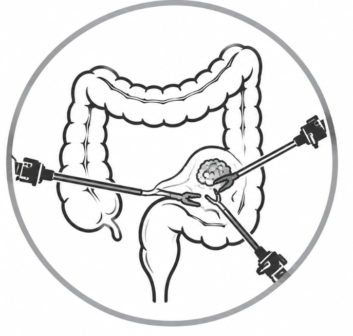 Upper Gastrointestinal Cancer Surgery